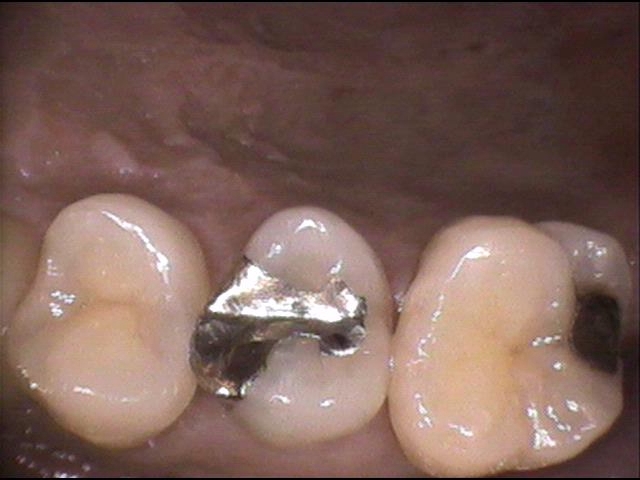 詰め物 の 下 の 虫歯