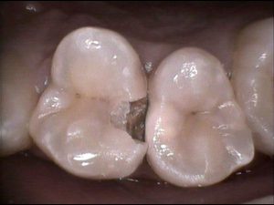 の 治療 後 痛い 歯 神経に近い虫歯を治療した場合の経過について教えてください。