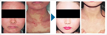 アトピー性皮膚炎の症状改善例1