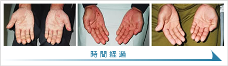 掌蹠膿疱症の症状改善例2