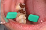 歯が接触する強さをはかるコンタクトゲージ
