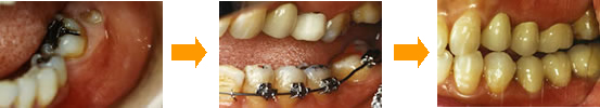 欠損歯の補綴（ほてつ）横から見た写真