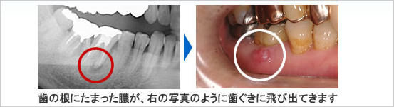 歯に根にたまった膿が、右の写真のように歯ぐきに飛び出てきます