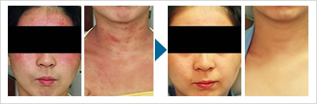 アトピー性皮膚炎の症状改善例2