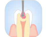 カリソルブインスツルメントを用いて、軟化した感染象牙質を注意深く掻き取る。インスツルメントは部位、アクセスの具合を考慮して選択する。