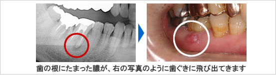 歯の根にたまった膿が歯ぐきに飛び出てきます