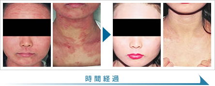 アトピー性皮膚炎の症状改善例1