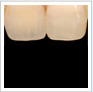 ノンメタル歯科治療