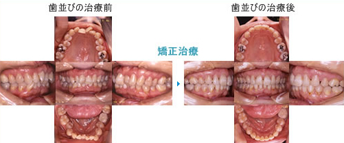 歯並びの改善