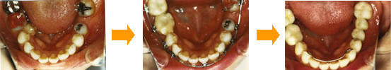 欠損歯の補綴（ほてつ）上から見た写真