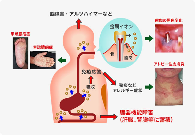 歯科金属の全身への害