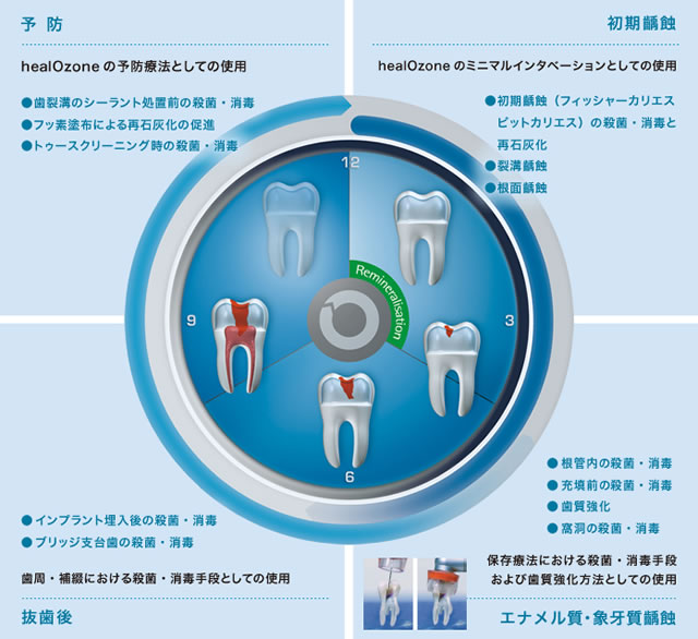 ヒールオゾンにより可能な治療