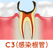 C3（感染根管）