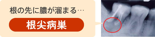 根の先に膿がたまる「根尖病巣」