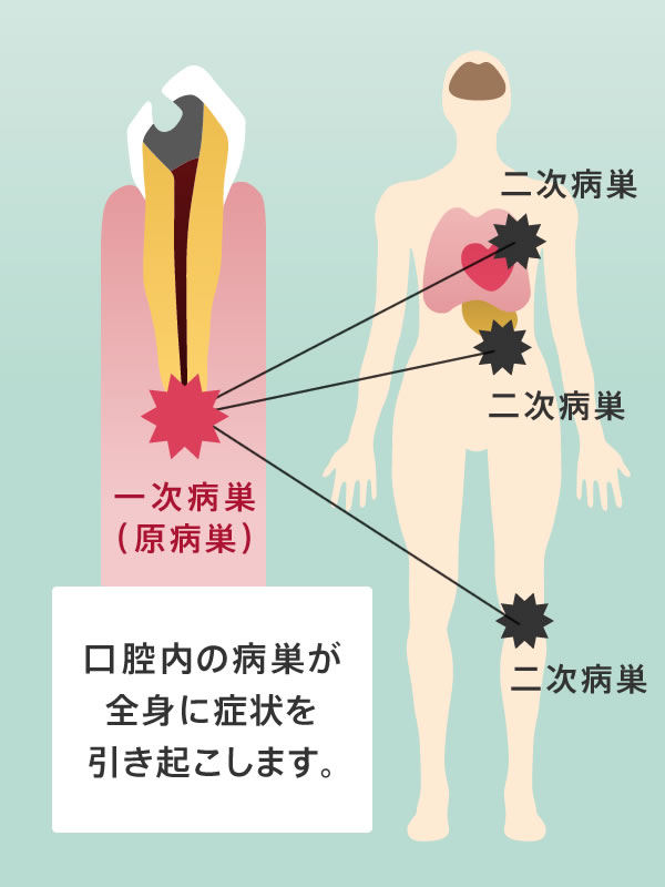 病巣感染の仕組み