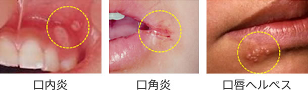 口内炎や口角炎、口唇ヘルペスなどに効きます